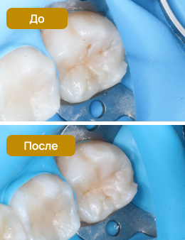 рентген зуба, лечение кариеса зуба приморский спб
