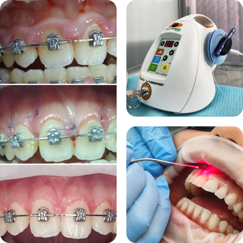 Лазерная стоматология, лазер PICASSO LITE, стоматологический диодный лазер.