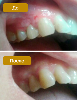 лечение десен лазеров в стоматологии СтомаЭстет
