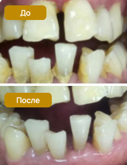 лазерное лечение зубов и десен в стоматологии СтомаЭстет