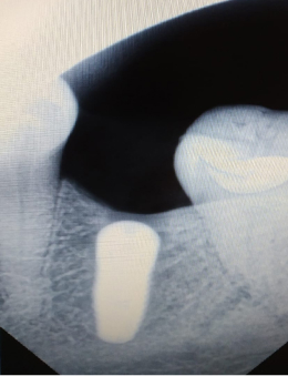 контроль имплантации зуба через снимок томографа.