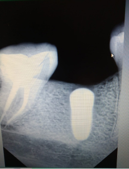 Имплантант зуба спб приморский