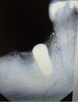 имплантат жевательного зуба, установлен в стоматологии СтомаЭстет