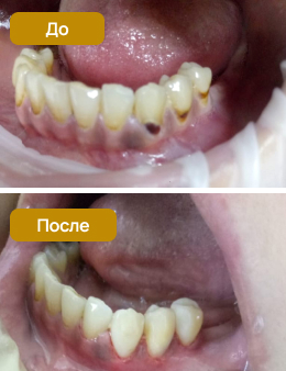 лечение кариеса зубов приморский район