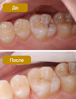 восстановление зуба световой пломбой, эстетическая реставрация зуба