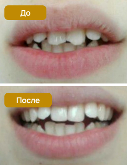 восстановление зуба световой пломбой, эстетическая реставрация зуба
